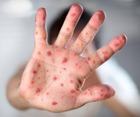 Amapá confirma as primeiras mortes por sarampo do país em 2021