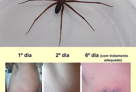 Salvador: Mulher é internada após ser picada por aranha