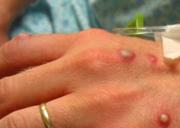 Anvisa sugere uso de máscara e isolamento para adiar chegada de varíola
