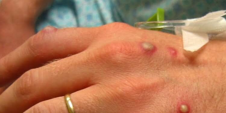 Anvisa sugere uso de máscara e isolamento para adiar chegada de varíola