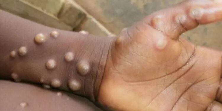 OMS confirma 780 casos de varíola dos macacos em 27 países