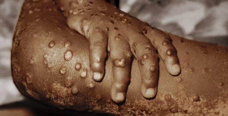 Anvisa orienta hospitais sobre casos de varíola dos macacos