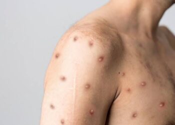 Salvador registra primeiro caso suspeito de varíola dos macacos