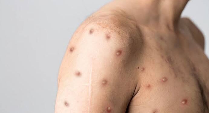 Salvador registra primeiro caso suspeito de varíola dos macacos