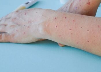 Mais dois casos de varíola dos macacos são confirmados em Salvador; são cinco no total