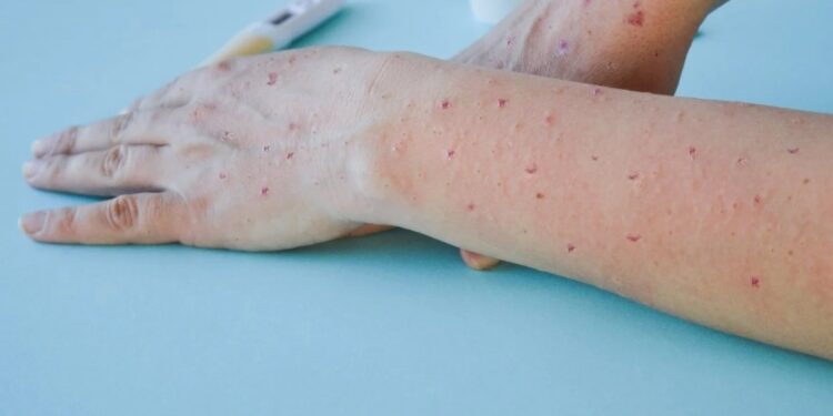 Mais dois casos de varíola dos macacos são confirmados em Salvador; são cinco no total