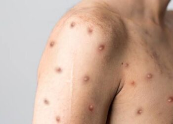 Segundo caso de varíola dos macacos é confirmado em Salvador