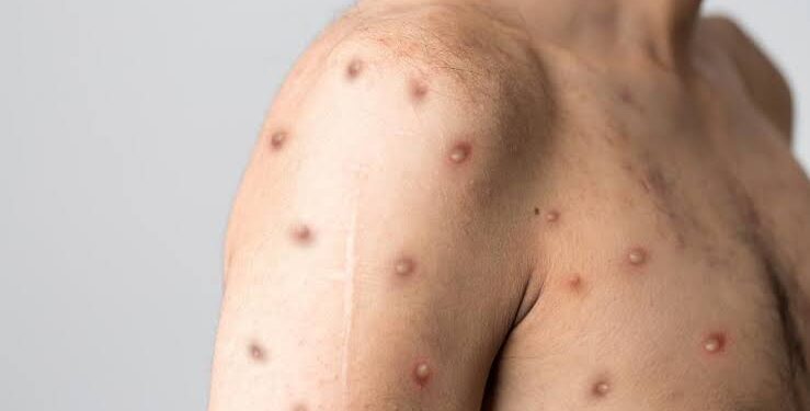 Segundo caso de varíola dos macacos é confirmado em Salvador