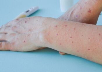 Salvador confirma 12º caso de varíola do macaco na cidade