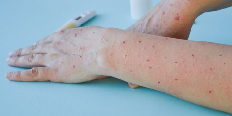 Salvador confirma 12º caso de varíola do macaco na cidade