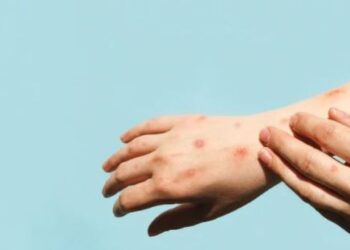 Bahia tem mais dois casos confirmados de varíola dos macacos