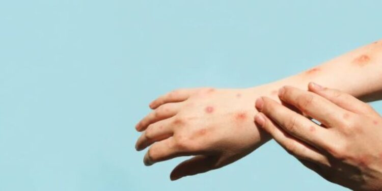 Bahia tem mais dois casos confirmados de varíola dos macacos