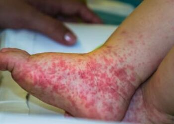 Gripe do tomate: entenda causas e sintomas da doença identificada na Índia