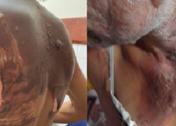 Mulher é queimada pelo companheiro com água fervente no interior da Bahia