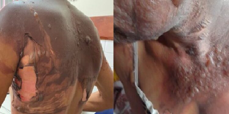 Mulher é queimada pelo companheiro com água fervente no interior da Bahia