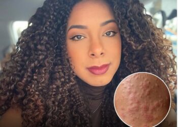 Jovem pega sarna humana após usar aparelhos na academia