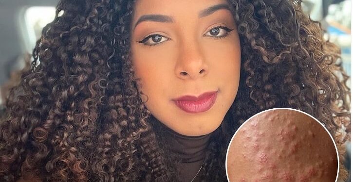 Jovem pega sarna humana após usar aparelhos na academia