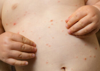 Após cinco anos, Brasil recupera certificado de país livre do sarampo