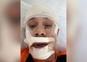 Homem tenta defender mulheres de assédio e é agredido; vítima levou 45 pontos no rosto