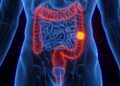 SUS adota novo exame para detectar câncer de intestino antes dos sintomas