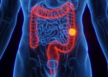 SUS adota novo exame para detectar câncer de intestino antes dos sintomas