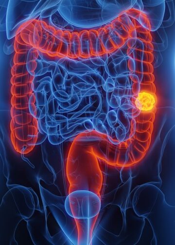 SUS adota novo exame para detectar câncer de intestino antes dos sintomas