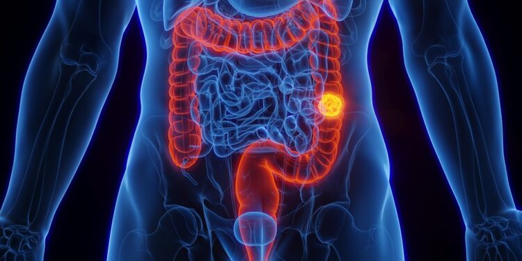 SUS adota novo exame para detectar câncer de intestino antes dos sintomas